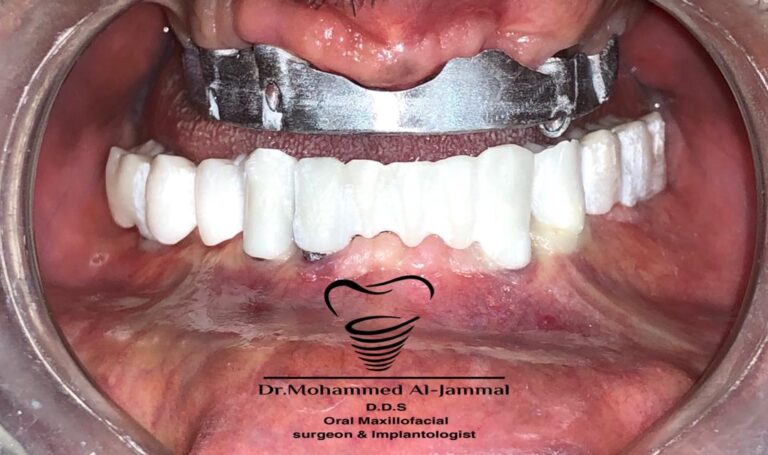 Tooth restoration using SGS Dental implants and prosthetics